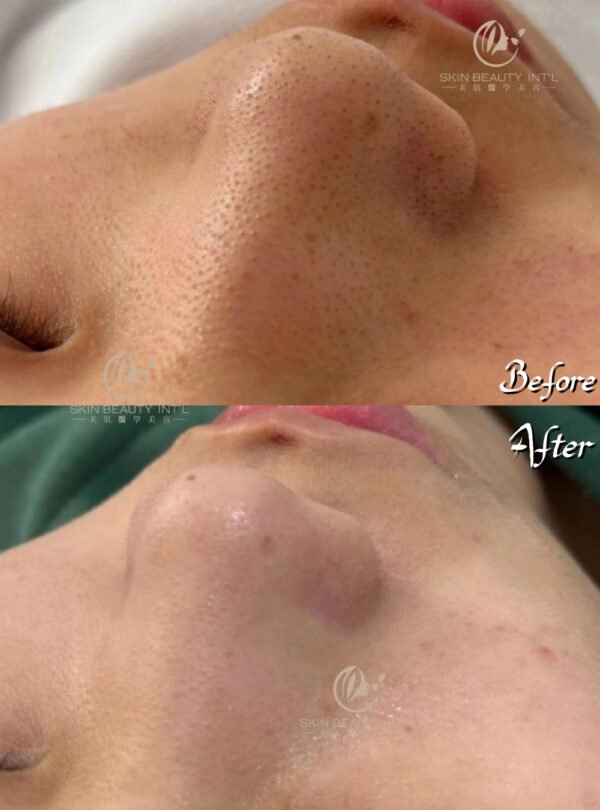 Aqua Peel Treatment - 图片 2